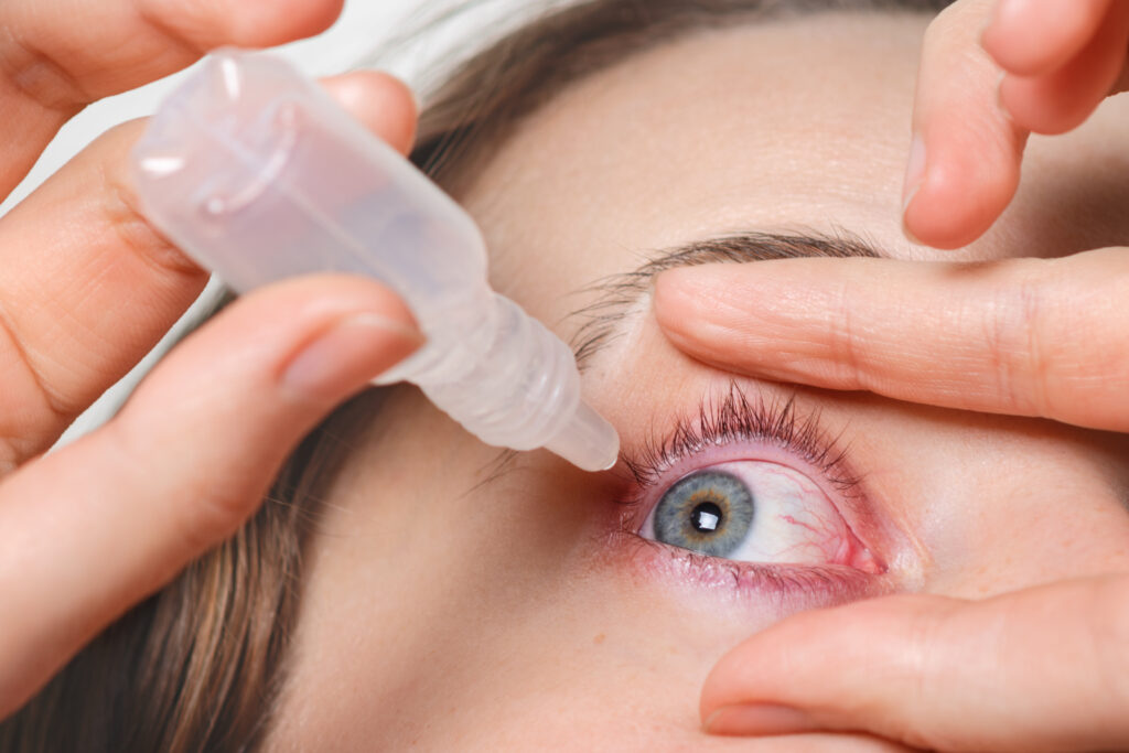 Conjuntivitis alérgica