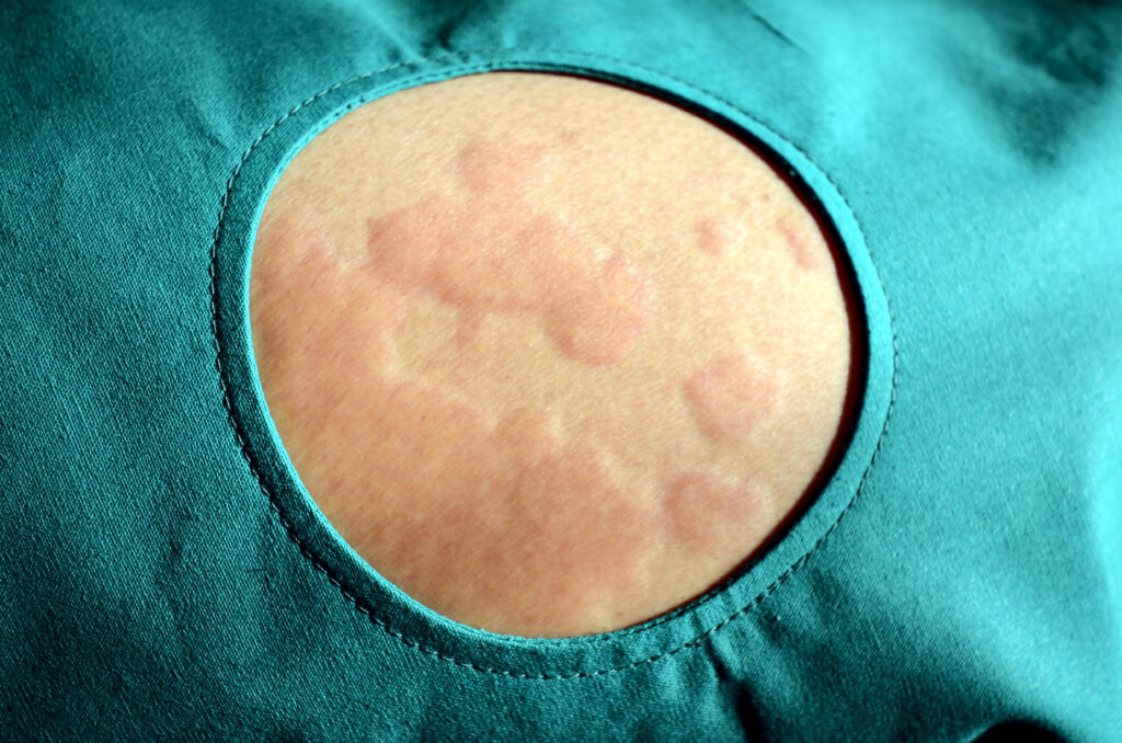 Urticaria y angioedema​