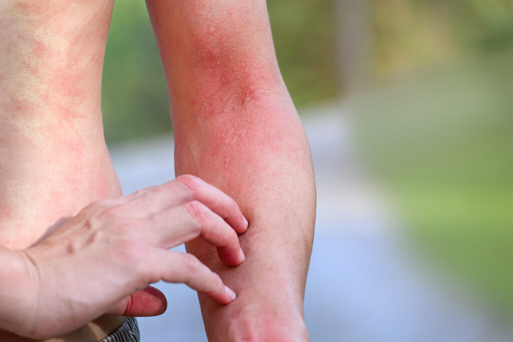 Dermatitis atópica​