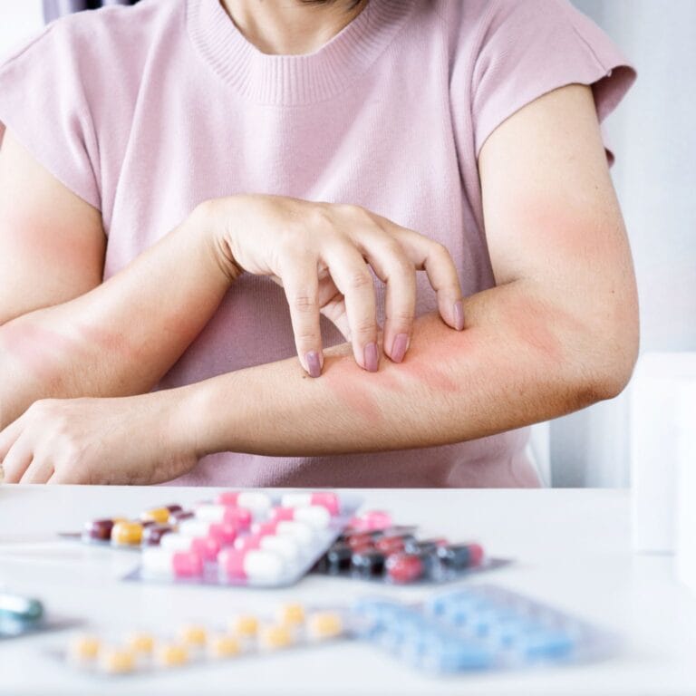 Alergia a fármacos diagnóstico síntomas y manejo