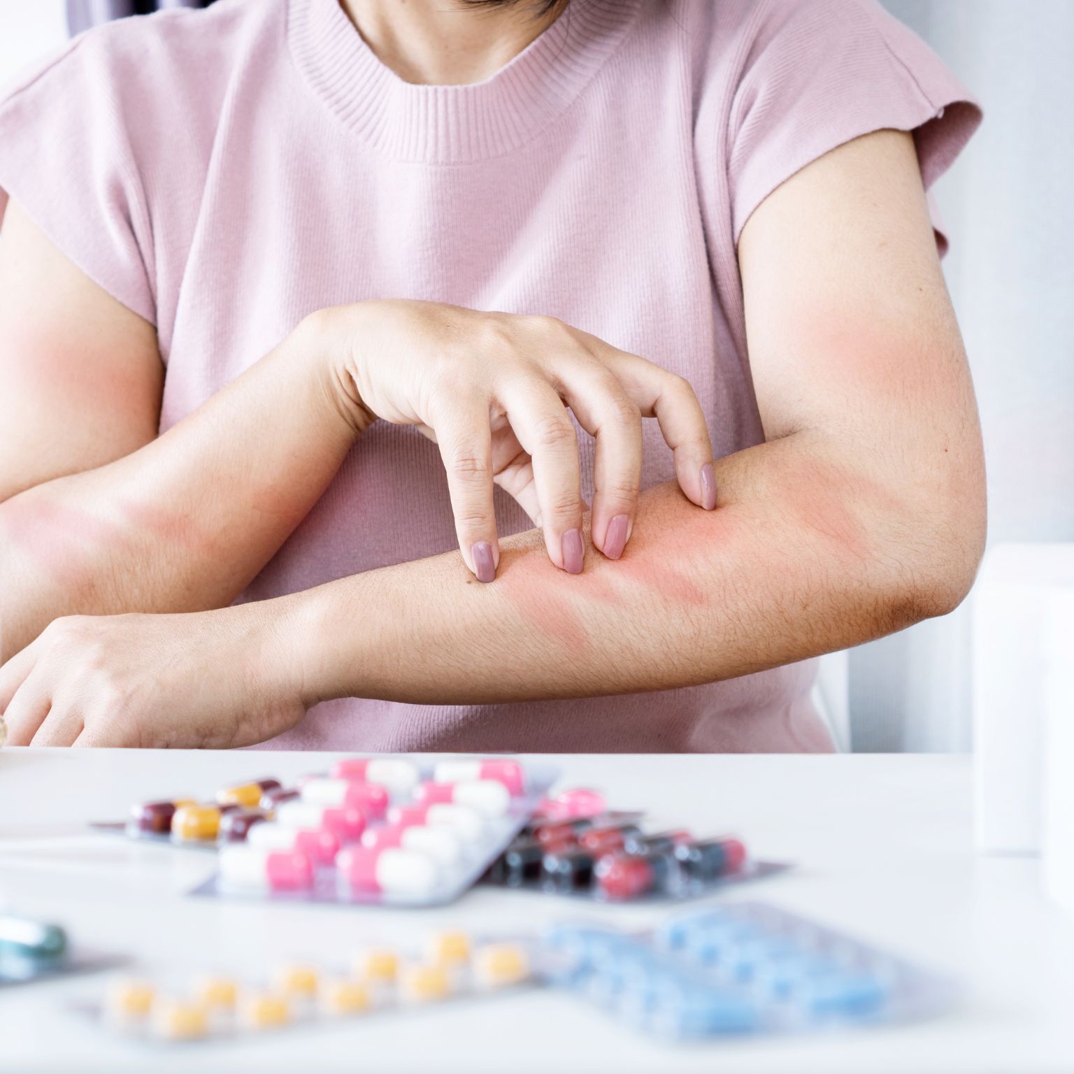 Alergia a fármacos: diagnóstico, síntomas y manejo
